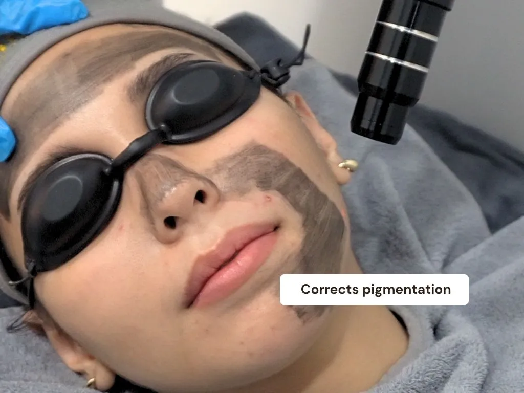 Carbon Laser